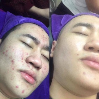 [ Chính Hãng ] Kem Mụn B.Star Cam Kết Chất Lượng Hiệu Quả Với Các Loại Mụn (Mẫu Mới Nhất)