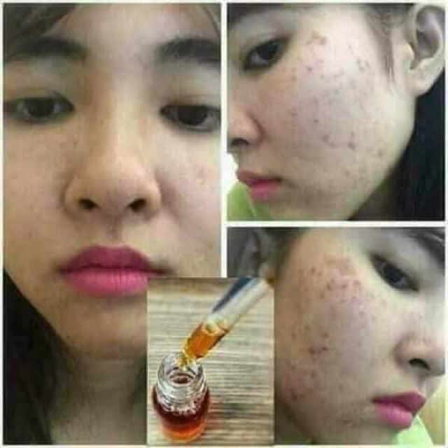 Serum kiều thảo dược