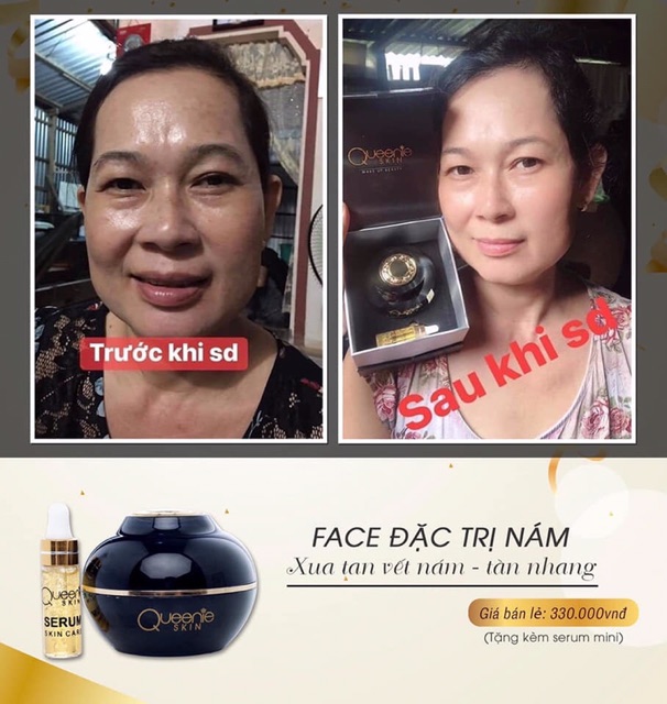 [TẶNG KÈM SERUM] KEM FACE NÁM TÀN NHANG QUEENIE SKIN | BigBuy360 - bigbuy360.vn