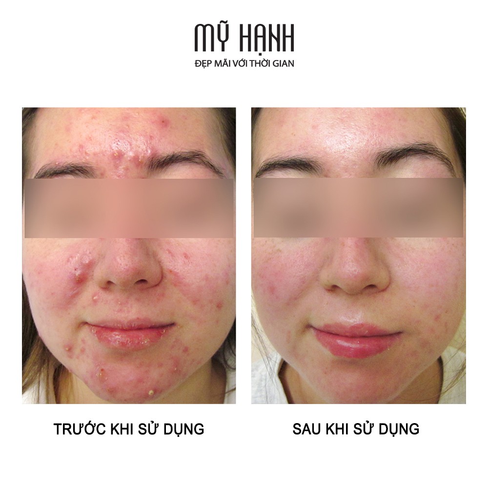 ACNE TREATMENT | SERUM MỤN NGHỆ PRISWHITE