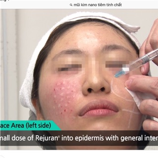 Đầu kim tiêm tinh chất 4mm