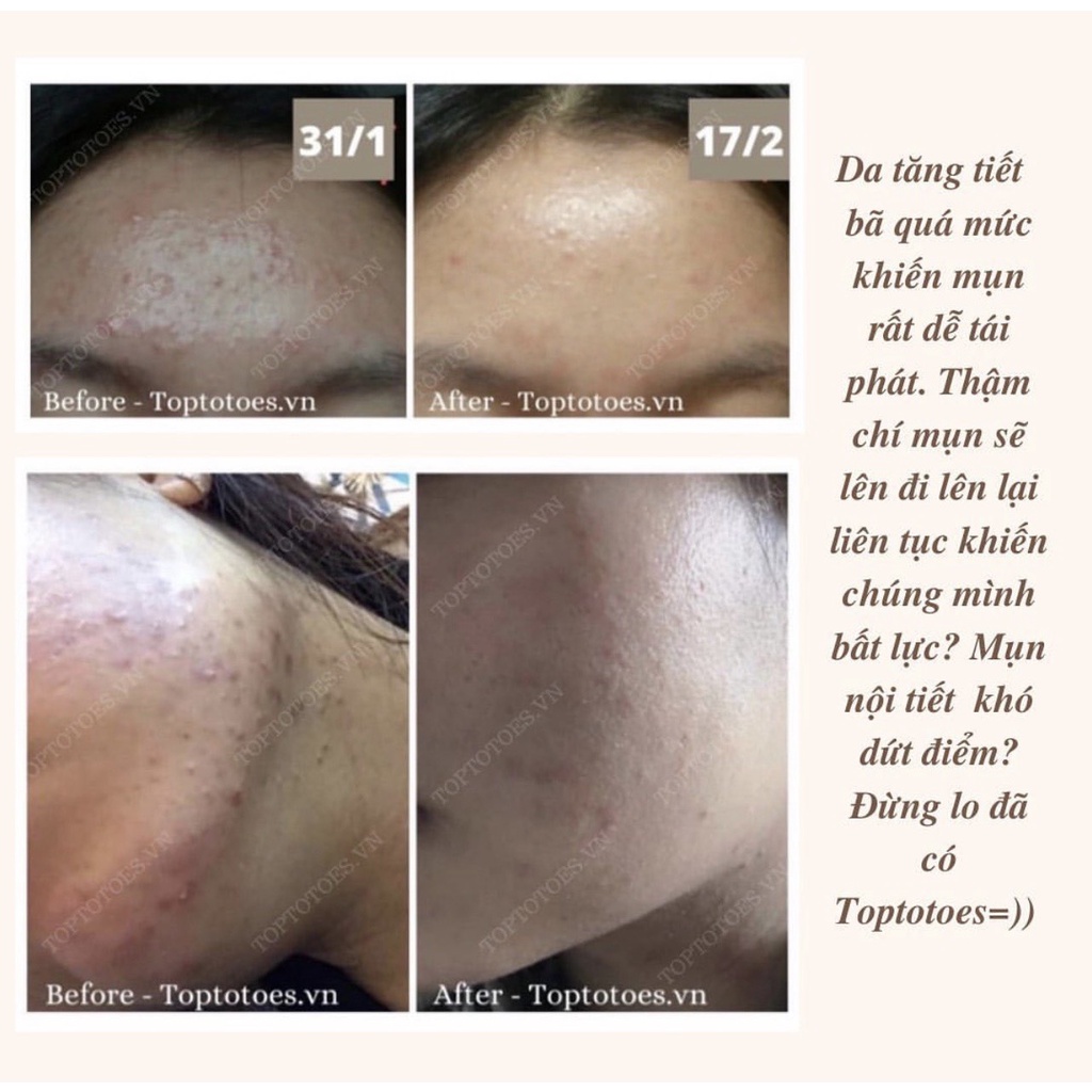 Serum Teana Anti-redness &amp; No Problem 10ml cho da mụn
