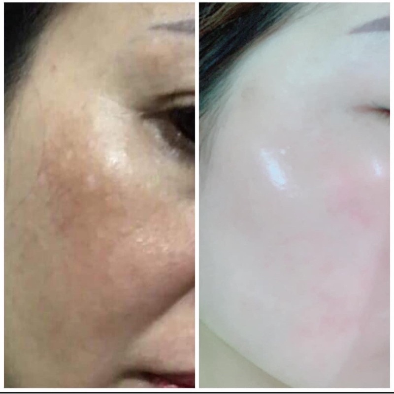 TÁI TẠO ĐÔNG Y L2 ĐEN MẠNH/ VÀNG NHẸ   Dành cho da NÁM-Lỗ chân lông to-Căng bóng da