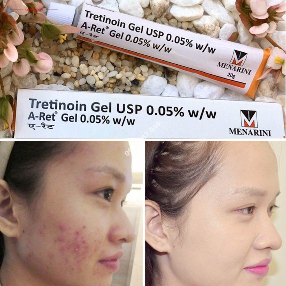 Tretinoin Aret gel 0.1% 0.05% 0.025% ngăn lão hóa, mụn (20g) - A ret tretinol và tre ấn độ