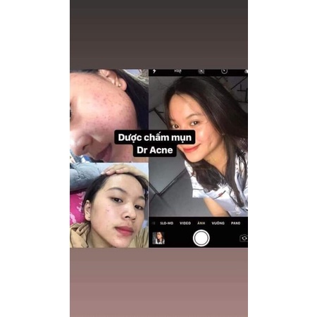 DƯỢC CHẤM MỤN ACNE(chính hãng niêm yết giá) | BigBuy360 - bigbuy360.vn