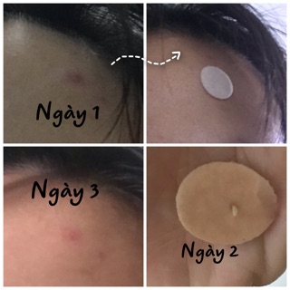 Miếng dán xẹp mụn tinh chất tràm trà