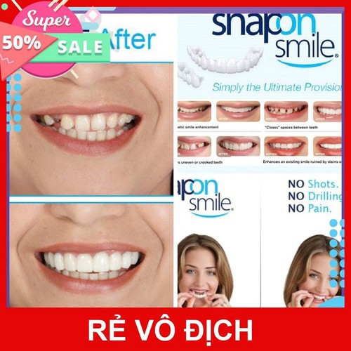 Nẹp răng Snapon Smile