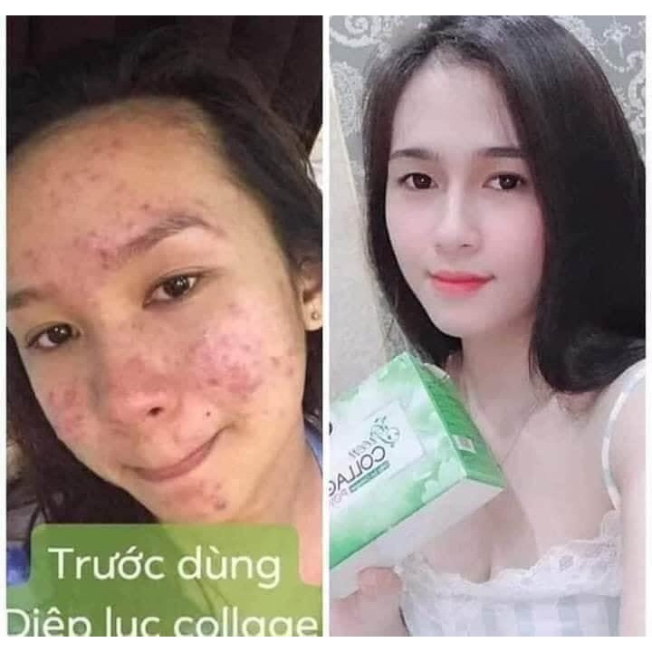 Diệp lục Colagen [TẶNG BÌNH NƯỚC] đẹp da hết mụn mờ thâm nám, bổ sung 1kg rau xanh