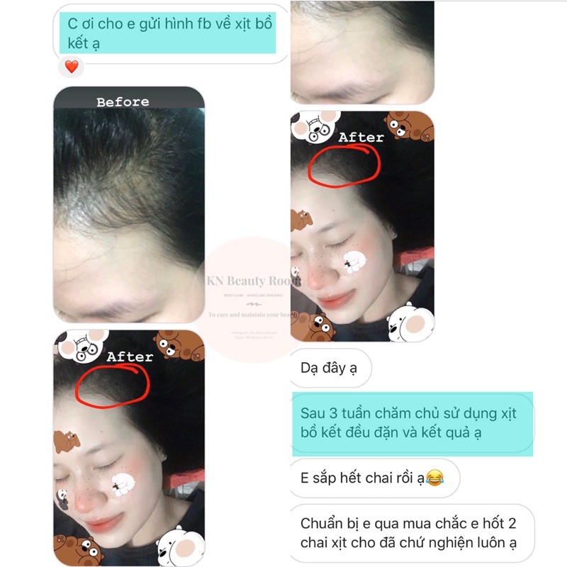 Xịt Tinh Chất Kích Mọc Tóc Giảm Rụng Trị Hói- KN Beauty Room | BigBuy360 - bigbuy360.vn