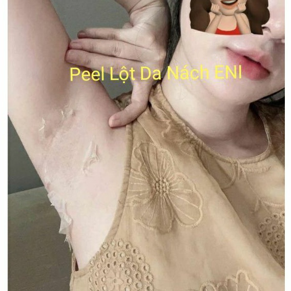 Peel Lột Nách Hết Thâm Sạm Trắng Da