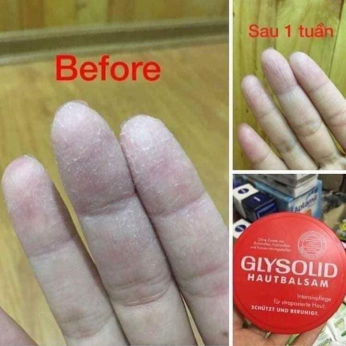 KEM NẺ, KEM NỨT GÓT CHÂN GLYSOLID ĐỨC SIÊU HIỆU QUẢ - HŨ ĐỎ 100G