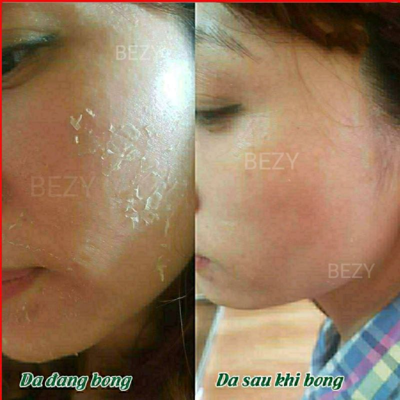 Kem Bong Da Mặt Trắng Da Mờ Thâm Nám