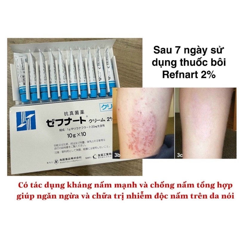 KEM BÔI DA NẤM ZEFNART 2% BỆNH VIỆN NHẬT