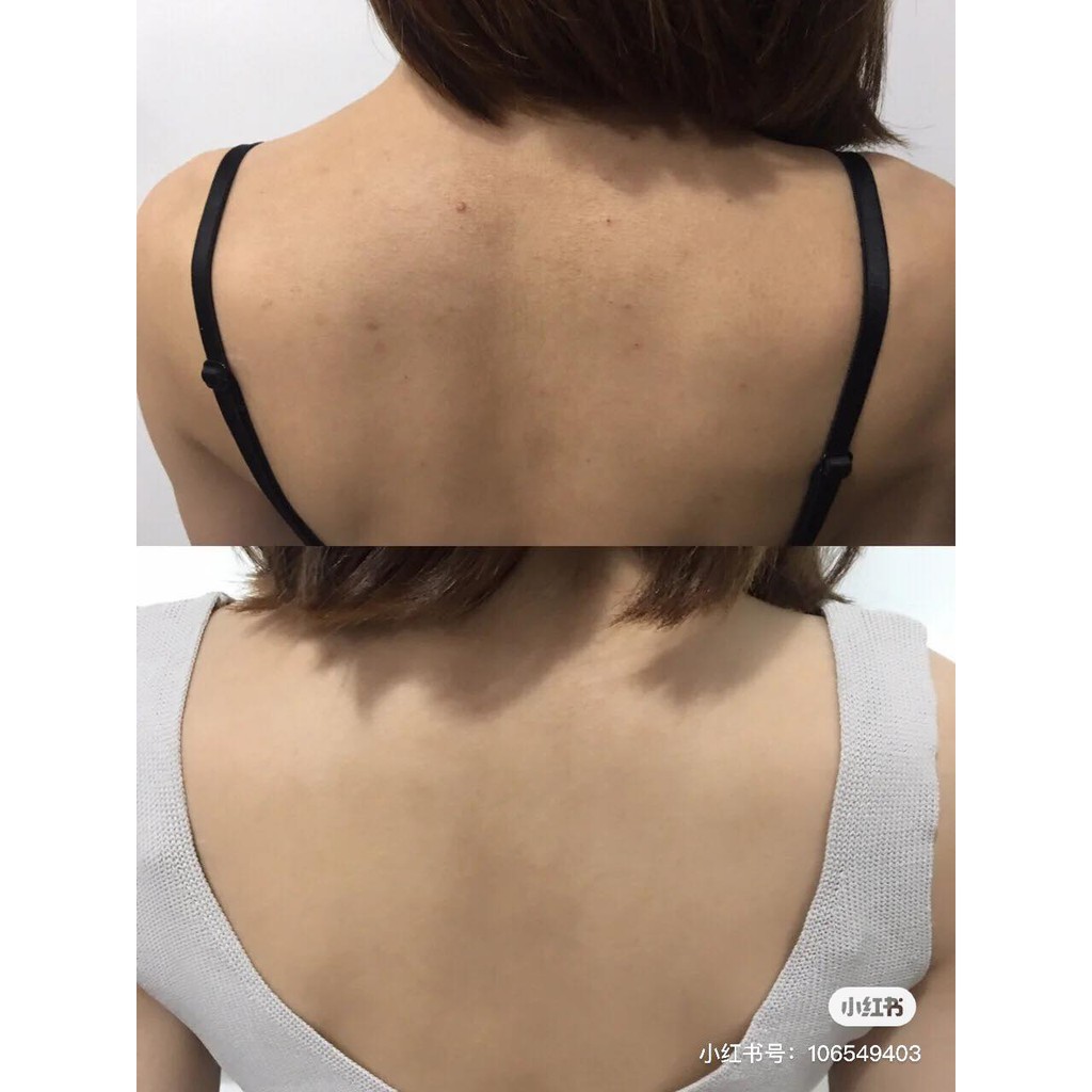 Xịt Hỗ Trợ Giảm Mụn Lưng For Back