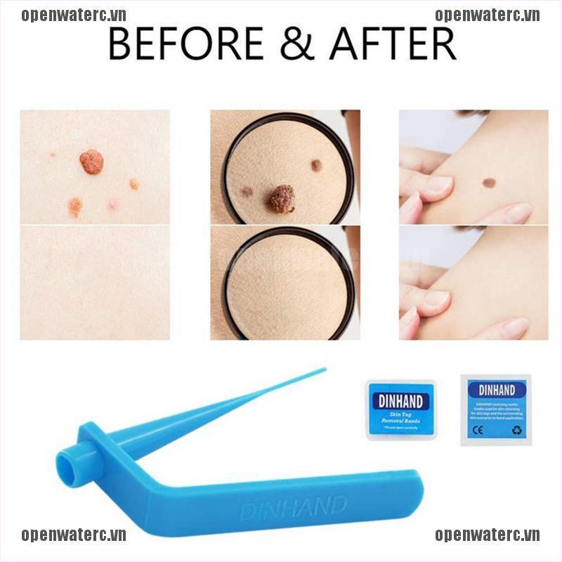 OPC Micro Tag Band Skin Tag Remover Kit for Fast & Effective Skin Tag Removal