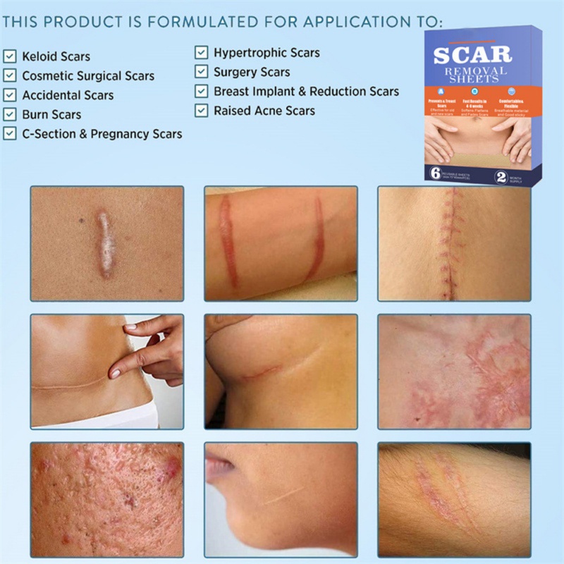 Hộp 6 Miếng Dán Sẹo Phẫu Thuật Kiểu Mới Tiện Dụng