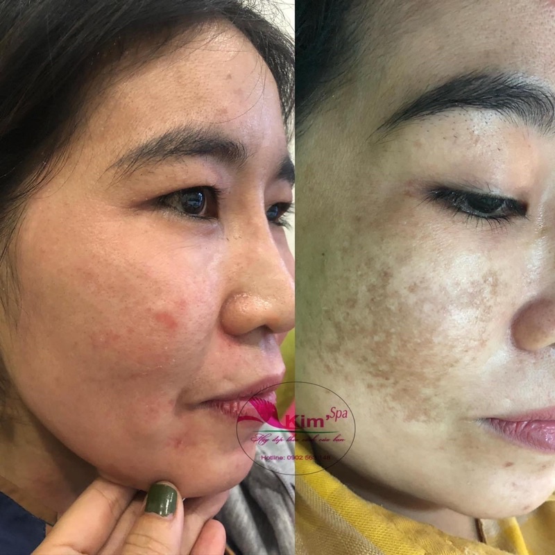 Kem Tái Tạo Da Đông Y Tái Tạo Da Mặt Hiệu Quả Xóa Tan Mụn Nám Tàn Nhang Dành Cho Bạn
