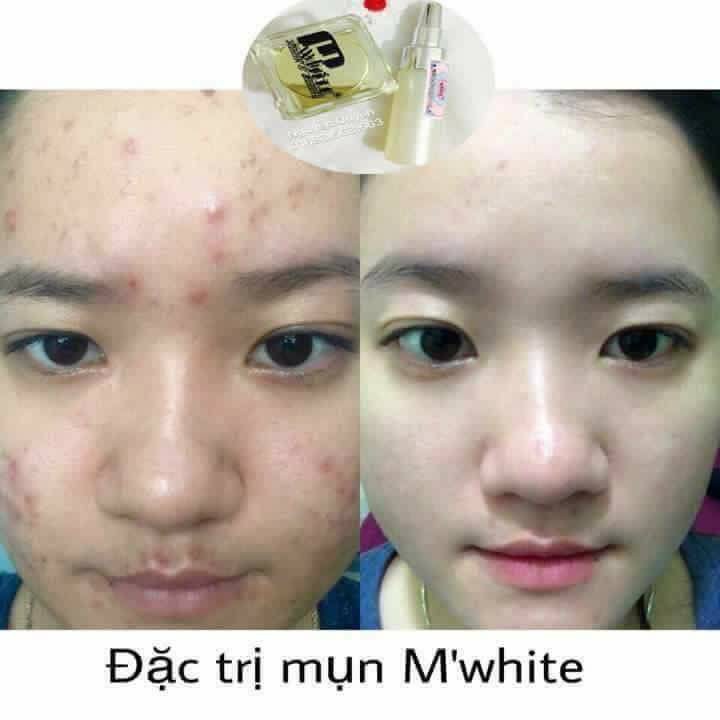 Kem đặc trị mụn mủ, mụn ẩn, mụn sưng đỏ,.. TẶNG nạ vitamin