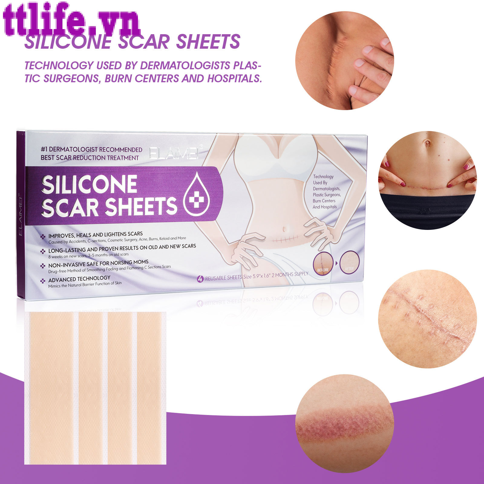 (Hàng Mới Về) Bộ 4 Miếng Dán Silicone Trị Sẹo Và Vết Bỏng Elaimei