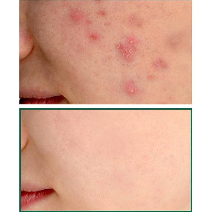 Kem Dưỡng Giảm Và Ngăn Ngừa Mụn Some By Mi AHA-BHA-PHA 30 Days Miracle Cream 60g