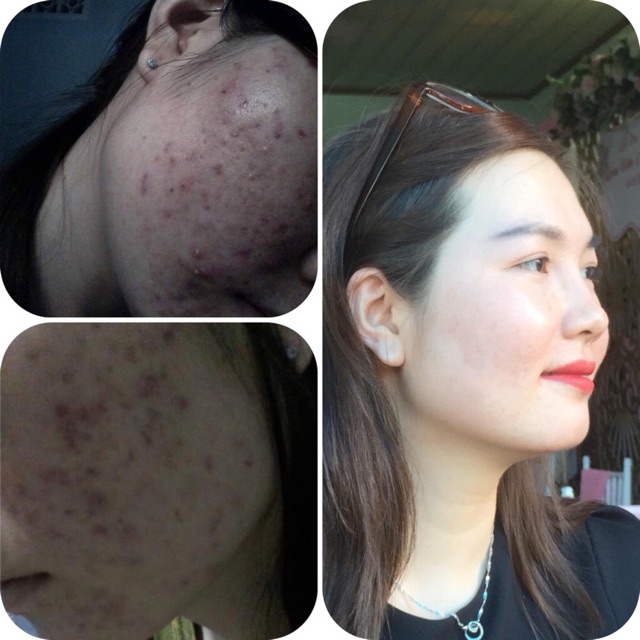 SERUM OGANA trị mụn