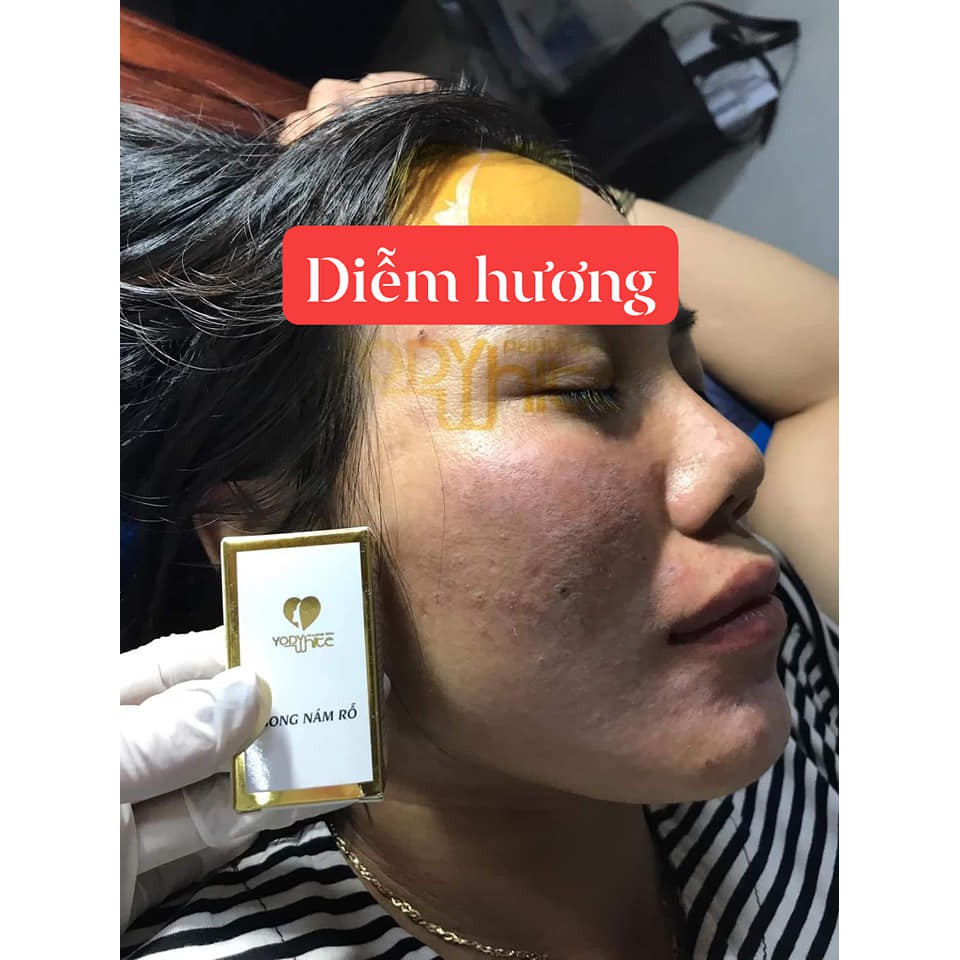 Bong nám rỗ Phương Anh - Serum bong nám rỗ Yody White Phương Anh