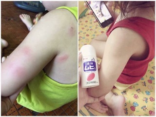 Lăn trị muỗi đốt Muhi của Nhật 