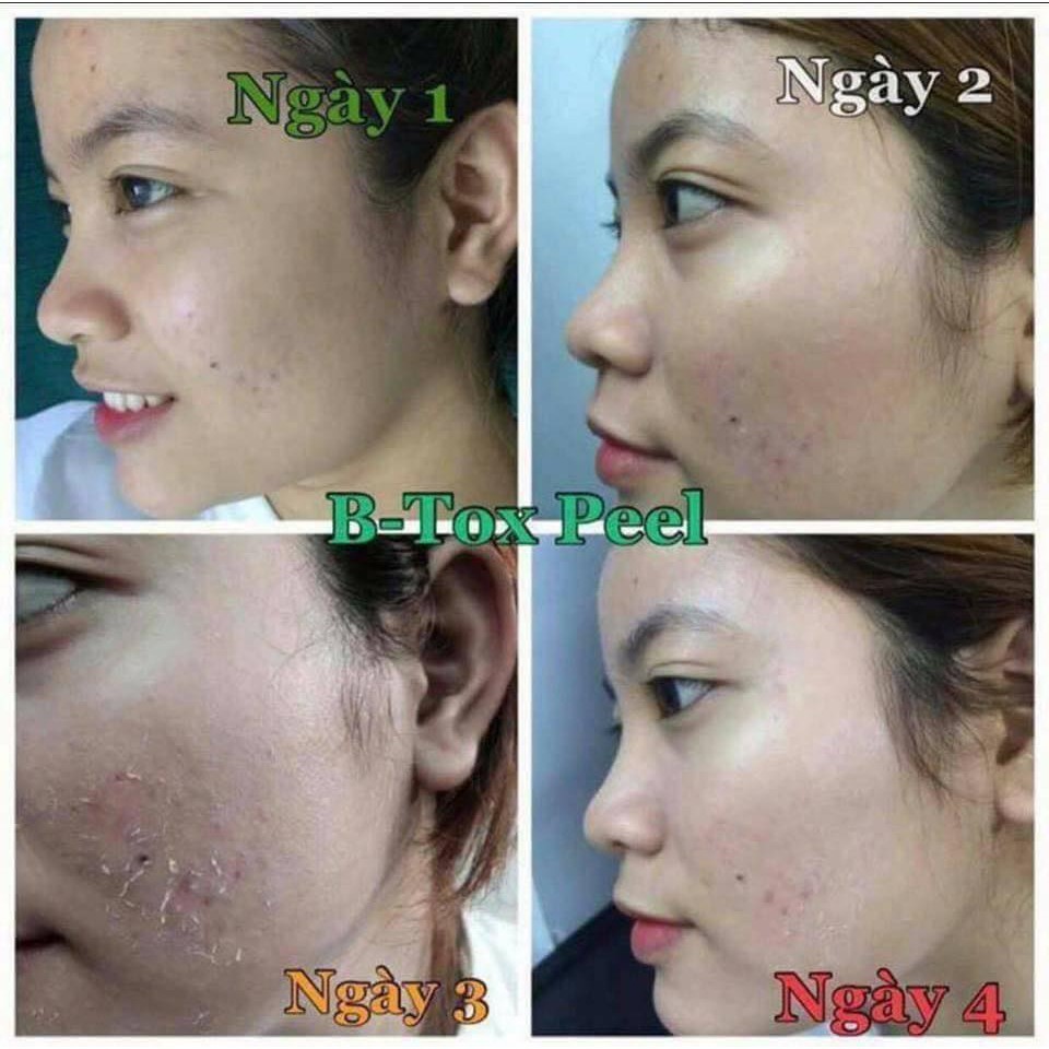 THAY DA SINH HỌC BTOX PEEL 2 MÀU