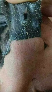 Gel lột mụn than tre