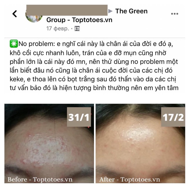 Serum Teana Super Peptides No Problem Intensive Care giảm sưng, đẩy & gom cồi mụn, giảm tiết dầu