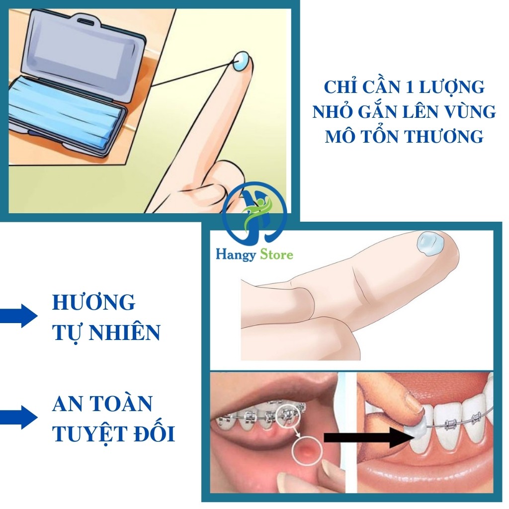 Sáp nha khoa dành cho người niềng răng chính hãng Diya