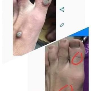 Trị mụn cóc mụn cơm