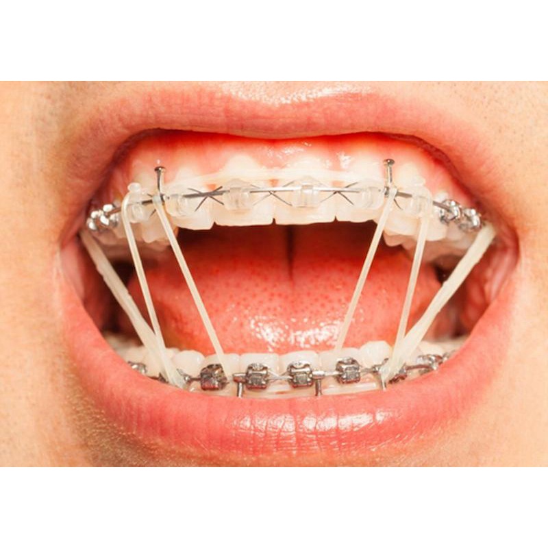 Cây móc chun liên hàm niềng răng, dụng cụ hỗ trợ chỉnh nha