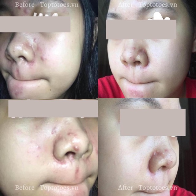 Kem dưỡng &amp; kem bôi Teana Skin To Kill giảm mụn sưng, đỏ