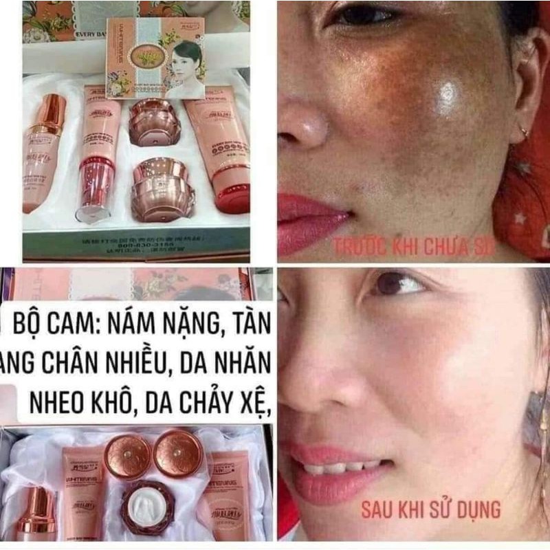 Hoàng Cung Cam Chính Hãng Danxuenilan 5in1 - Bộ Chăm Sóc Da Nám