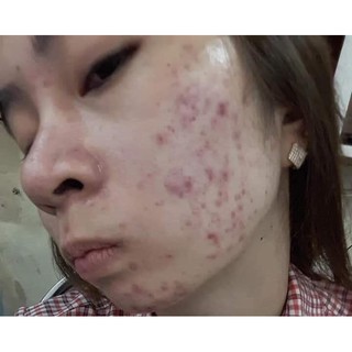Combo tái tạo da Phương Anh