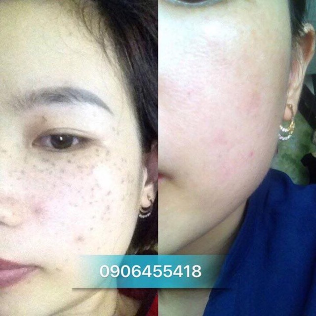 Chấm nám chân sâu , nám đinh