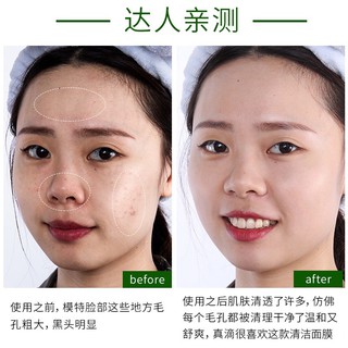 MẠT NẠ BÌ HEO SỦI BỌT THẢI ĐỘC BIOAQUA