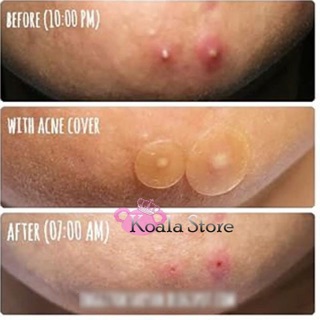 Dán mụn y tế Acne Pimple Master Patch #COSRX