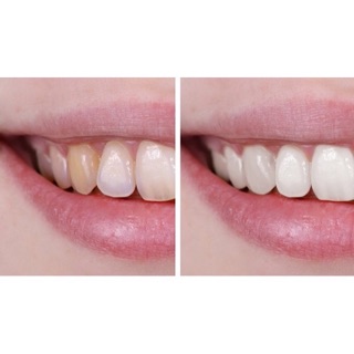Combo 4 lọ chống nắng