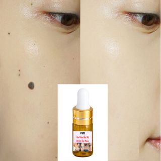 Kem Xóa Nốt Ruồi Mụn Thịt Tàn Nhang