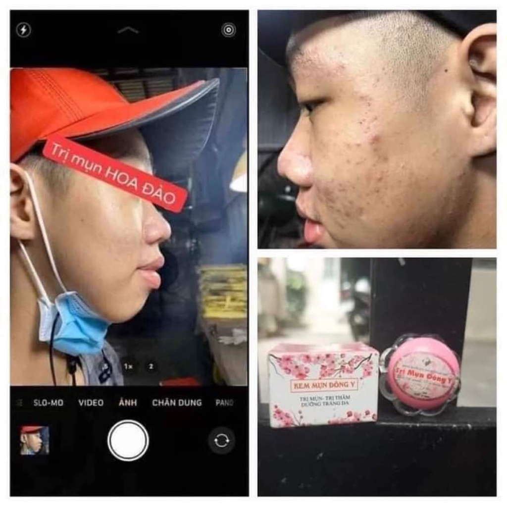 Kem mụn Đông y Hoa Đào làm sạch mụn, dưỡng trắng da, mờ nám