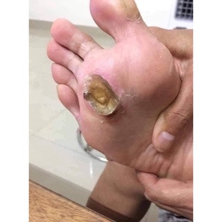 [HÀNG THÁI] KEM CHẤM MỤN CÓC,MUN RUOI, MUN THIT THÁI LAN