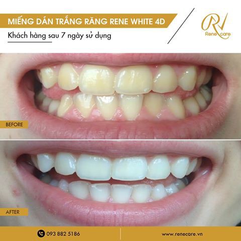 Miếng Dán Trắng Răng -  Rene White 4D