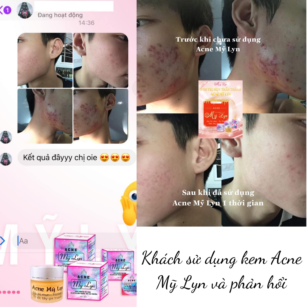 Kem Mụn Acne Mỹ Lyn Giúp Giảm Mụn, Ngừa Thâm Hiệu Qủa Sau 7-10 Ngày Sử Dụng