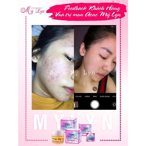 Acne Mỹ Lyn size lớn 10gram (Kèm quà tặng độc quyền) | BigBuy360 - bigbuy360.vn