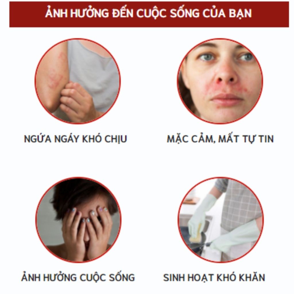 Bôi Da Thiên Ân ❤️[ CHÍNH HÃNG ] ❤️ Hỗ Trợ Vảy Nến, Á Sừng, Chàm, Nấm Ghẻ
