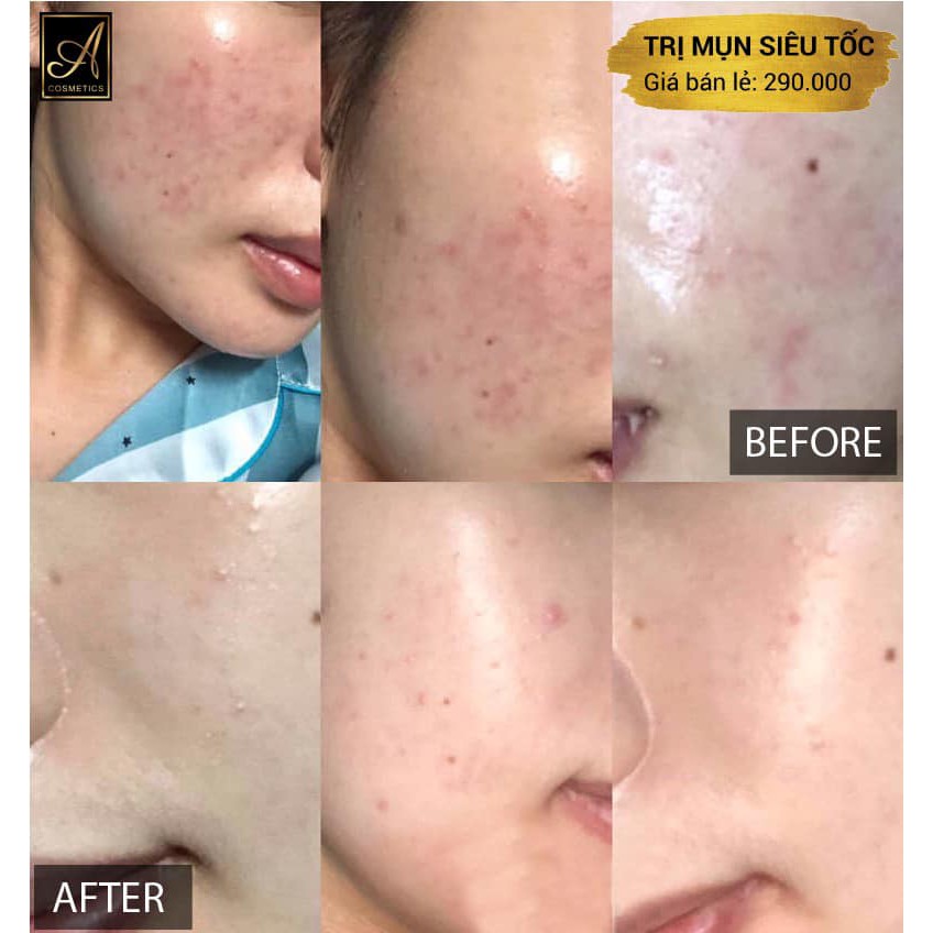 Kem Ngừa Mụn Siêu Tốc Độ Acosmetics, Gồm serum chấm mụn và Kem dưỡng ngừa thâm