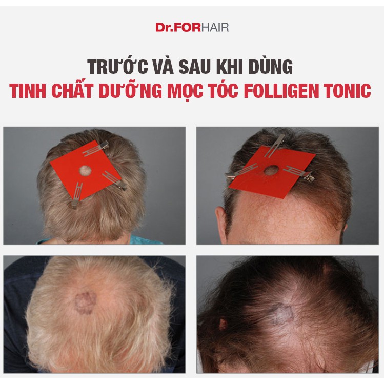 Bộ gội xả dưỡng HỖ TRỢ MỌC TÓC, nuôi dưỡng da đầu khỏe mạnh của Dr.FORHAIR: Folligen Plus x Scalp Pack x Tonic