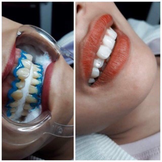 đèn tẩy trắng .